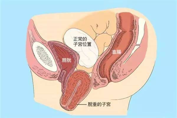 【產(chǎn)后修復(fù)】盆腔臟器脫垂，你有嗎？