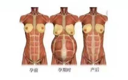小巧便攜式產(chǎn)后康復(fù)治療儀，跟腹直肌分離說拜拜