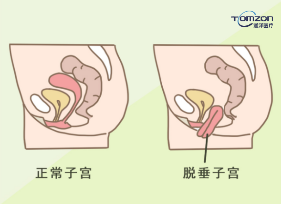 你害怕子宮脫垂嗎？盆底肌修復(fù)儀器來(lái)拯救你